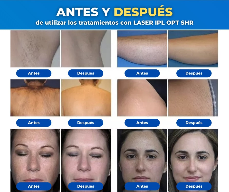 Laser Ipl Depilacion A Laser Duele Ipl Diodo O Alejandrita La